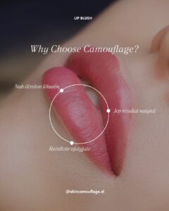 Skin camouflage